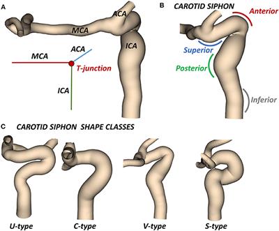 Impact of the Internal Carotid Artery Morphology on in silico Stent-Retriever Thrombectomy Outcome